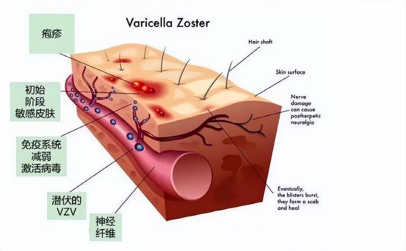 焦虑自救：带状疱疹的防御与心理重建