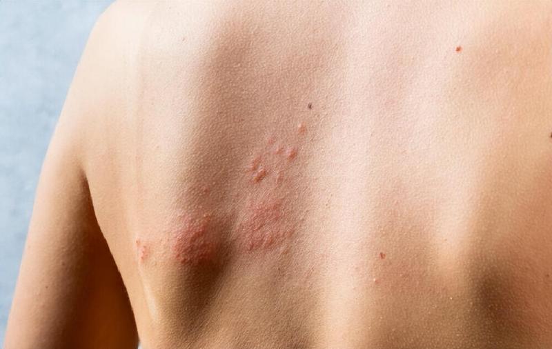  焦虑自救：带状疱疹的防御与心理重建 健康养生